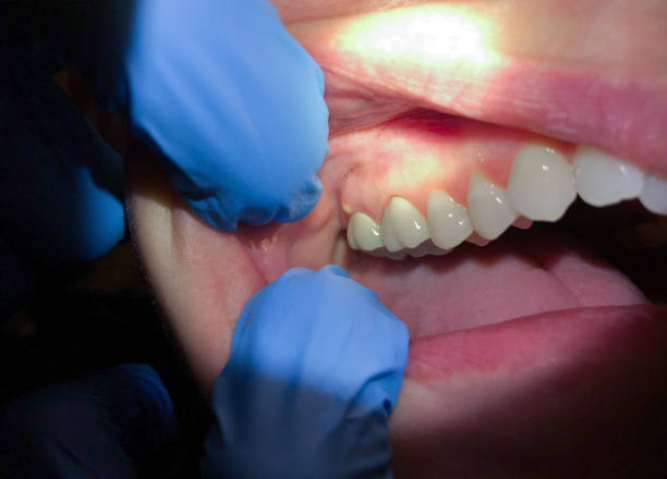 Best Broken or Chipped Tooth Repair in Forest Park, GA